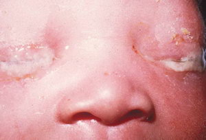 Гоноккоковый конъюнктивит у малышей