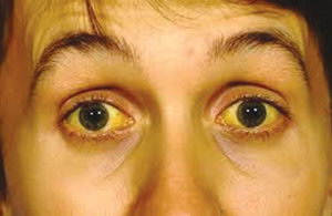 Желтые круги под глазами при болезни печени