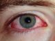 Покраснение глаз на начальной стадиии вирусного конъюнктивита