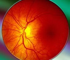 Глаз при ангиопатии гипертонического типа
