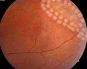 Виды дистрофии сетчатки глаза