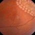 Виды дистрофии сетчатки глаза