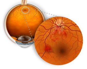 Механизм возникновения ангиопатии сетчатки глаза