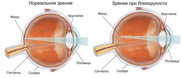 Анатомическая структура глаза и близорукость