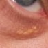 Расположение жировиков у глаза