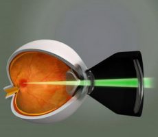 Схема воздействи лазера на глаз