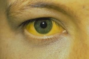 Желтый белок глаза