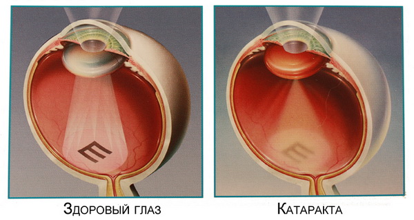 Схема катаракты
