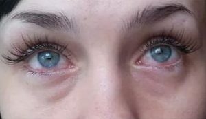 Покраснения глаз после наращивания ресниц
