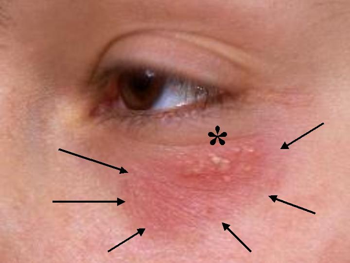 Герпес на глазу: лечение и симптомы заболевания, классификация и ...