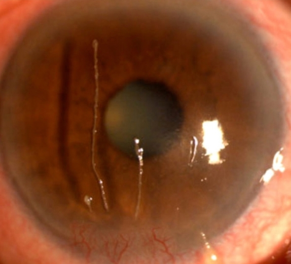 Нитчатый кератит: лечение и симптомы у человека, причины и последствия  заболевания глаз