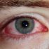 Покраснение глаз на начальной стадиии вирусного конъюнктивита