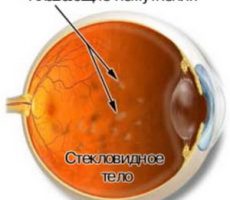 Механизм возникновения деструкции стекловидного тела глаза