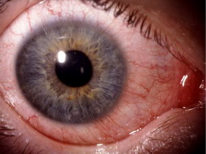 Покраснение глаз в следствии конъюнктивита