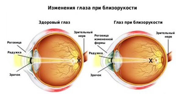 Овальный глаз при миопии
