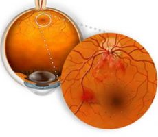 Механизм возникновения ангиопатии сетчатки глаза