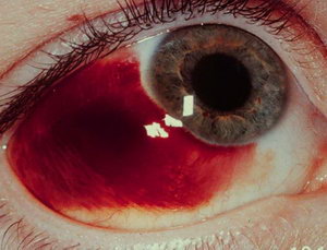 Покраснение склеры глаза причины лечение thumbnail