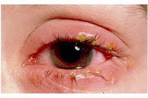 Может демодекоз глаз быть от аллергии thumbnail