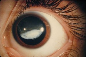 Изображение - Глазное давление и артериальное давление glaukoma2-300x200