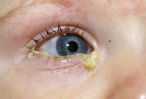 Конъюнктивит глаз у детей до года фото thumbnail